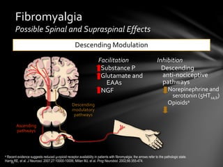 Fibromyalgia
Possible Spinal and Supraspinal Effects
Descending Modulation
Facilitation
Substance P
Glutamate and
EAAs
NGF
Inhibition
Descending
anti-nociceptive
pathways
Norepinephrine and
serotonin (5HT1a,b)
Opioidsa
Ascending
pathways
Descending
modulatory
pathways
a Recent evidence suggests reduced µ-opioid receptor availability in patients with fibromyalgia; the arrows refer to the pathologic state.
Harris RE, et al. J Neurosci. 2007;27:10000-10006; Millan MJ, et al. Prog Neurobiol. 2002;66:355-474.
 