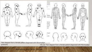 Pain diagram from a female patient diagnosed with fibromyalgia
syndrome ‘ All over’ Pain diagram from a female patient diagnosed with fibromyalgia
syndrome
Reumatismo, 2012; 64 (4): 194-205
 