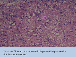 Zonas del fibrosarcoma mostrando degeneración grasa en los
fibroblastos tumorales.
