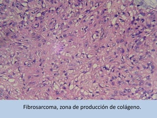 Fibrosarcoma, zona de producción de colágeno.