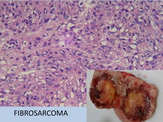 FIBROSARCOMA