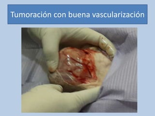 Tumoración con buena vascularización