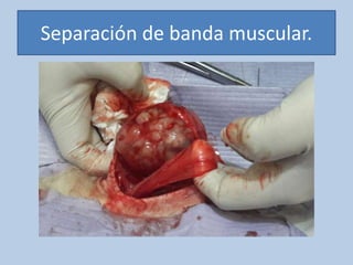 Separación de banda muscular.