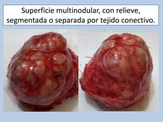 Superficie multinodular, con relieve,
segmentada o separada por tejido conectivo.