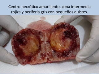 Centro necrótico amarillento, zona intermedia
rojiza y periferia gris con pequeños quistes.