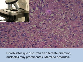 Fibroblastos que discurren en diferente dirección,
nucléolos muy prominentes. Marcado desorden.