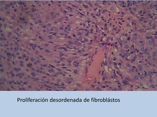 Proliferación desordenada de fibroblástos