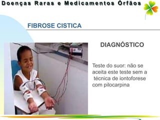 FIBROSE CISTICA


                     DIAGNÓSTICO


                  Teste do suor: não se
                  aceita este teste sem a
                   técnica de iontoforese
                  com pilocarpina




                              Ir p/ primeira página
 