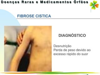 FIBROSE CISTICA




                     DIAGNÓSTICO

                  Desnutrição
                  Perda de peso devido ao
                  excesso rápido do suor




                               Ir p/ primeira página
 