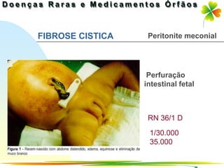 FIBROSE CISTICA    Peritonite meconial




                   Perfuração
                  intestinal fetal



                   RN 36/1 D

                   1/30.000
                   35.000

                          Ir p/ primeira página
 