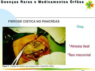 FIBROSE CISTICA NO PANCREAS
                                      Diag.




                              *Atresia ileal

                              *Íleo meconial


                                Ir p/ primeira página
 