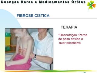 FIBROSE CISTICA


                   TERAPIA

                  *Desnutrição :Perda
                  de peso devido o
                   suor excessivo




                            Ir p/ primeira página
 
