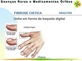 FIBROSE CISTICA             ADULTOS

Unha em forma de baqueta digital




                              Ir p/ primeira página
 
