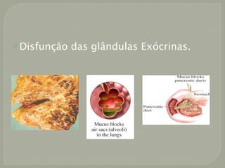  Disfunção   das glândulas Exócrinas.
 