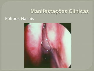 Manifestações Clínicas
Pólipos Nasais
 