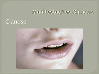 Manifestações Clínicas
Cianose
 