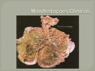 Manifestações Clínicas
 