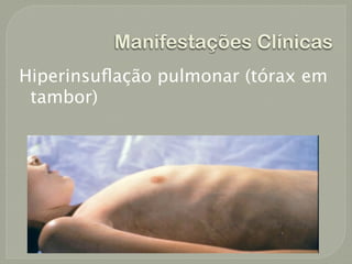 Manifestações Clínicas
Hiperinsuﬂação pulmonar (tórax em
 tambor)
 