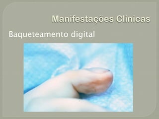 Manifestações Clínicas
Baqueteamento digital
 