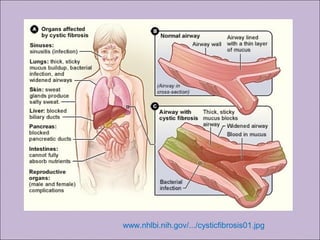 Fibrose císticaFibrose cística
www.nhlbi.nih.gov/.../cysticfibrosis01.jpg
 