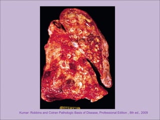 Kumar: Robbins and Cotran Pathologic Basis of Disease, Professional Edition , 8th ed., 2009
 