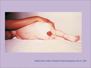 Zitelli & Davis: Atlas of Pediatric Physical Diagnosis, 5th ed., 2007
 