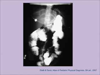 Zitelli & Davis: Atlas of Pediatric Physical Diagnosis, 5th ed., 2007
 