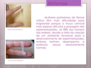 Mulheres portadoras de fibrose
cística têm mais dificuldade para
engravidar porque o muco cervical
mais espesso dificulta a passagem dos
espermatozoides. Já 98% dos homens
são estéreis, devido a falta da criação
de um ambiente favorável para o
desenvolvimento de espermatozoides,
embora tenham desempenho e
potência sexual absolutamente
normais.
Muco Cervical Espesso
Muco Cervical Normal
 