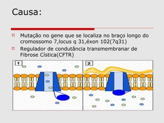 Causa:




Mutação no gene que se localiza no braço longo do
cromossomo 7,locus q 31,éxon 102(7q31)
Regulador de condutância transmembranar de
Fibrose Cística(CFTR)

 