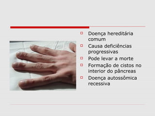 








Doença hereditária
comum
Causa deficiências
progressivas
Pode levar a morte
Formação de cistos no
interior do pâncreas
Doença autossômica
recessiva

 