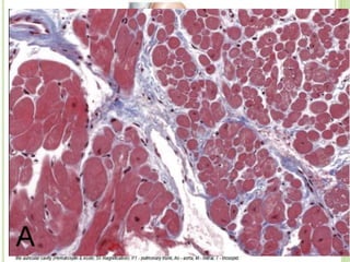 17
MACRO HISTOLOGIA
• Espessamento fibroso do
endocárdio ventricular D
e/ou E ++ no ápice e
espessamento dos
músculos papilares c/
regurgitação valvular;
• Geralmente trombo
subjacente;
• Auricula dilatada ++;
• Ventriculo pequeno;
• 50% ambos ventriculos,
40% apenas o esq e 10%
apenas o dir.
• Espessamento pronunciado do endocárdio
formado por deposição de colágeno TI cobrindo
o endocárdio normal;
• Enfarte subendocárdio;
• Degeneração da média, depósitos de fibrina e
fibrose nas artérias coronárias;
• Infiltrado crónico inflamatório na interface entre
o miocárdio e endocárdio e á volta dos vasos
intersticiais;
• Em mtas necrópsias há falta de celularidade
inflamatória no último estadio não há
inflamação.
 
