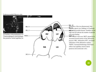 Endomyocardial fibrosis echo
A) Surface echocardiogram with fibrosis and thrombus in the left ventricular apex. B)
Transesophageal echocardiogram with biventricular apical fibrosis with involvement of
the posterior mitral papillary muscle and a small pericardial effusion.
Schematic of the two-dimensional, four-
chamber apical view findings in 10 patients
with endmyocardial disease. Numbers on the
right and left indicate the number of patients
with each finding.
IVC: inferior vena cava; MOT: preserved or
increased inward motion of the obliterative
process; OBL: obliteration; RFL: increased
reflectance of the obliterative surface;
THICK: increased thickening of the basal
inflow tract papillary muscle and/or
posterior atrioventricular valve.
28
 