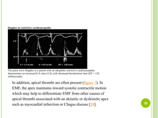 Doppler in restrictive cardiomyopathy
The pulse wave Doppler in a patient with an idiopathic restrictive cardiomyopathy
demonstrates an increased E/A ratio (2.4), with shortened deceleration time (DT = 128
milliseconds).
In addition, apical thrombi are often present (figure 7). In
EMF, the apex maintains inward systolic contractile motion
which may help to differentiate EMF from other causes of
apical thrombi associated with an akinetic or dyskinetic apex
such as myocardial infarction or Chagas disease [39]. 29
 