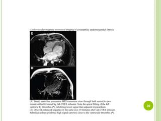 Cardiovascular magnetic resonance imaging of eosinophilic endomyocardial fibrosis
(A) Steady state free precession MRI transverse view through both ventricles two
minutes after 0.2-mmol/kg Gd-DTPA infusion. Note the apical filling of the left
ventricle by thrombus (*) exhibiting lower signal than adjacent myocardium.
(B) Delayed enhanced sequence in the same axis 10 minutes after Gd-DTPA infusion.
Subendocardium exhibited high signal (arrows) close to the ventricular thrombus (*).
30
 