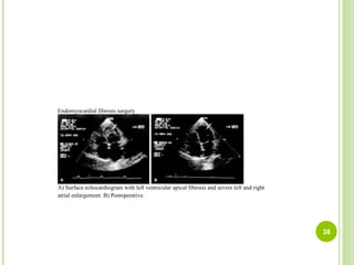 Endomyocardial fibrosis surgery
A) Surface echocardiogram with left ventricular apical fibrosis and severe left and right
atrial enlargement. B) Postoperative.
38
 