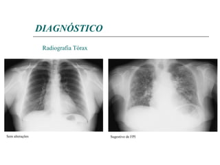 DIAGNÓSTICO Radiografia Tórax Sem alterações Sugestivo de FPI 