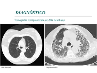 Tomografia Computorizada de Alta Resolução Sugestivo de FPI Sem alterações DIAGNÓSTICO 