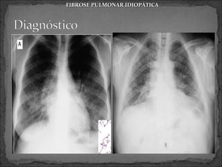 FIBROSE PULMONAR IDIOPÁTICA
 
