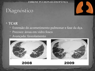 FIBROSE PULMONAR IDIOPÁTICA




 TCAR
  Extensão do acometimento pulmonar e fase da dça.
  Precoce: áreas em vidro fosco
  Avançada: faveolamento
 