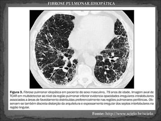 FIBROSE PULMONAR IDIOPÁTICA




                 Fonte: http://www.scielo.br/scielo
 