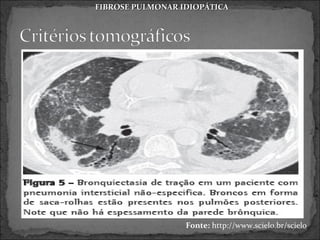 FIBROSE PULMONAR IDIOPÁTICA




                  Fonte: http://www.scielo.br/scielo
 