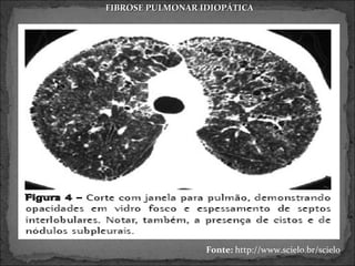 FIBROSE PULMONAR IDIOPÁTICA




                  Fonte: http://www.scielo.br/scielo
 
