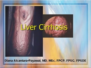 Liver Cirrhosis Diana Alcantara-Payawal, MD, MSc, FPCP, FPSG, FPSDE 