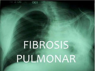 FIBROSIS
PULMONAR
 