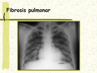 Fibrosis pulmonar

 