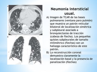 Neumonía intersticial
usual.
A) Imagen de TCAR de las bases
pulmonares (ventana para pulmón)
que muestra un patrón reticular
bilateral de localización simétrica
y subpleural asociado a
bronquiectasias de tracción
(cabeza de flecha). Los pequeños
quistes subpleurales de tamaño
milimétrico (flechas) son un
hallazgo característico de este
patrón.
B) La reconstrucción coronal
demuestra claramente la
localización basal y la presencia de
panalización (flechas)
 