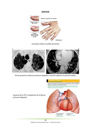 ANEXOS 
Acropatía o dedos en palillos de tambor 
TAC de paciente con fibrosis pulmonar idiopática, muestra imágenes en panal de abejas. 
Esquema de la HTP, complicación de la fibrosis 
pulmonar idiopática 
10 
FIBROSIS PULMONAR IDIOPÁTICA – FISIOPATOLOGÍA II 
 