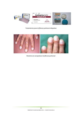 Tratamientos para la fibrosis pulmonar idiopatica 
Paciente con acropatía en la fibrosis pulmonar 
11 
FIBROSIS PULMONAR IDIOPÁTICA – FISIOPATOLOGÍA II 
