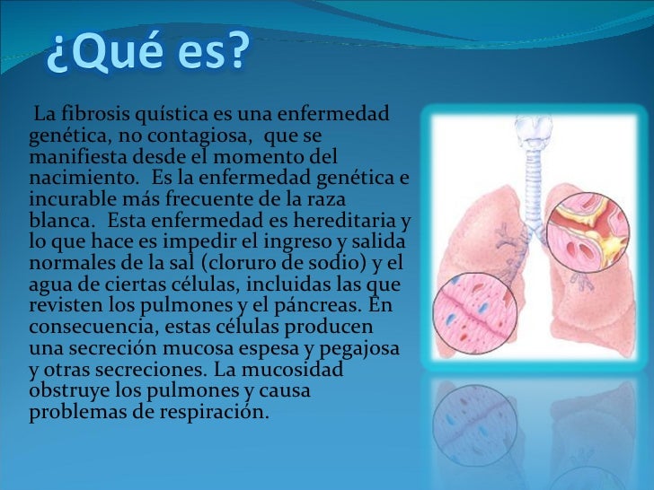 Fibrosis quistica Fibrosis quistica