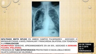 INFILTRADO MIXTO DIFUSO EN AMBOS CAMPOS PULMONARES , ASOCIADO A
BRONQUIECTASIAS, A NIVEL PARAHILIAR Y PARACARDIAL BILATERAL CON TENDENCIA
A LA PANALIZACION
NEUMOTORAX DERECHO, APROXIMADAMENTE EN UN 50%, ASOCIADO A DERRAME
PLEURAL IPSILATERAL
PRESENCIA DE TUBO INTRATORACICO PROYECTADO O HACIA LOBULO MEDIO
SILUETA CARDIACA NO VALORABLE
RX DE TORAX
08-11-2016
19:11
EMERGENCIA
 